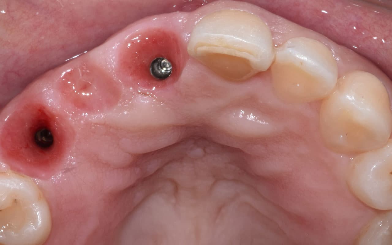 Protesis-fija-implanto-soportada-1