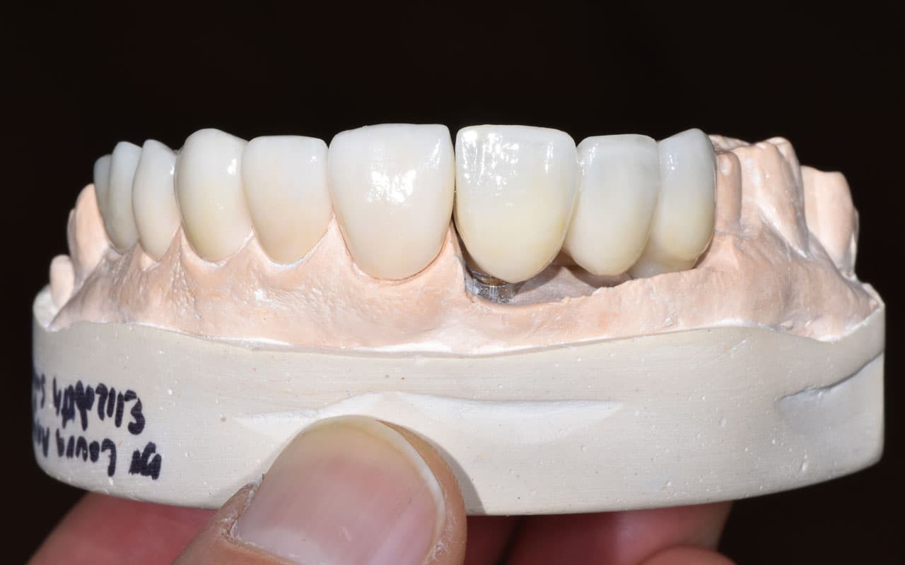 Protesis-fija-implanto-soportada-3
