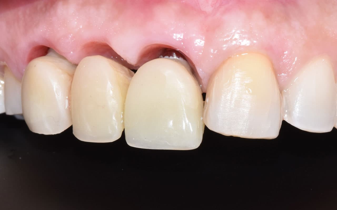 Protesis-fija-implanto-soportada-4